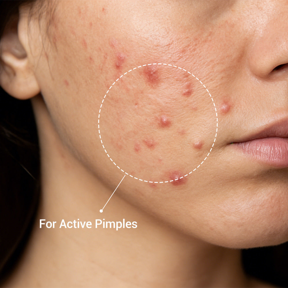 Findglee Salicylic Acid Drying Lotion with Niacinamide, Sulfur & Zinc Oxide for Acne