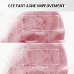 Findglee Salicylic Acid Drying Lotion with Niacinamide, Sulfur & Zinc Oxide for Acne