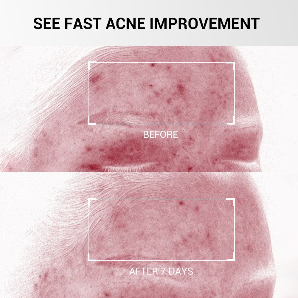 Findglee Salicylic Acid Drying Lotion with Niacinamide, Sulfur & Zinc Oxide for Acne