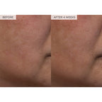 Findglee PHA + BHA Pore Tight Toner with Watermelon Extract & Glycerin for Pore