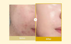 Findglee Kojic Acid & Turmeric Overnight Peel-Off Mask featuring Vitamin C & Retinol