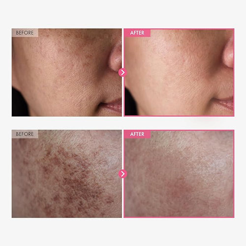 Arbutin 7% & Tranexamic Acid 4% Cream
