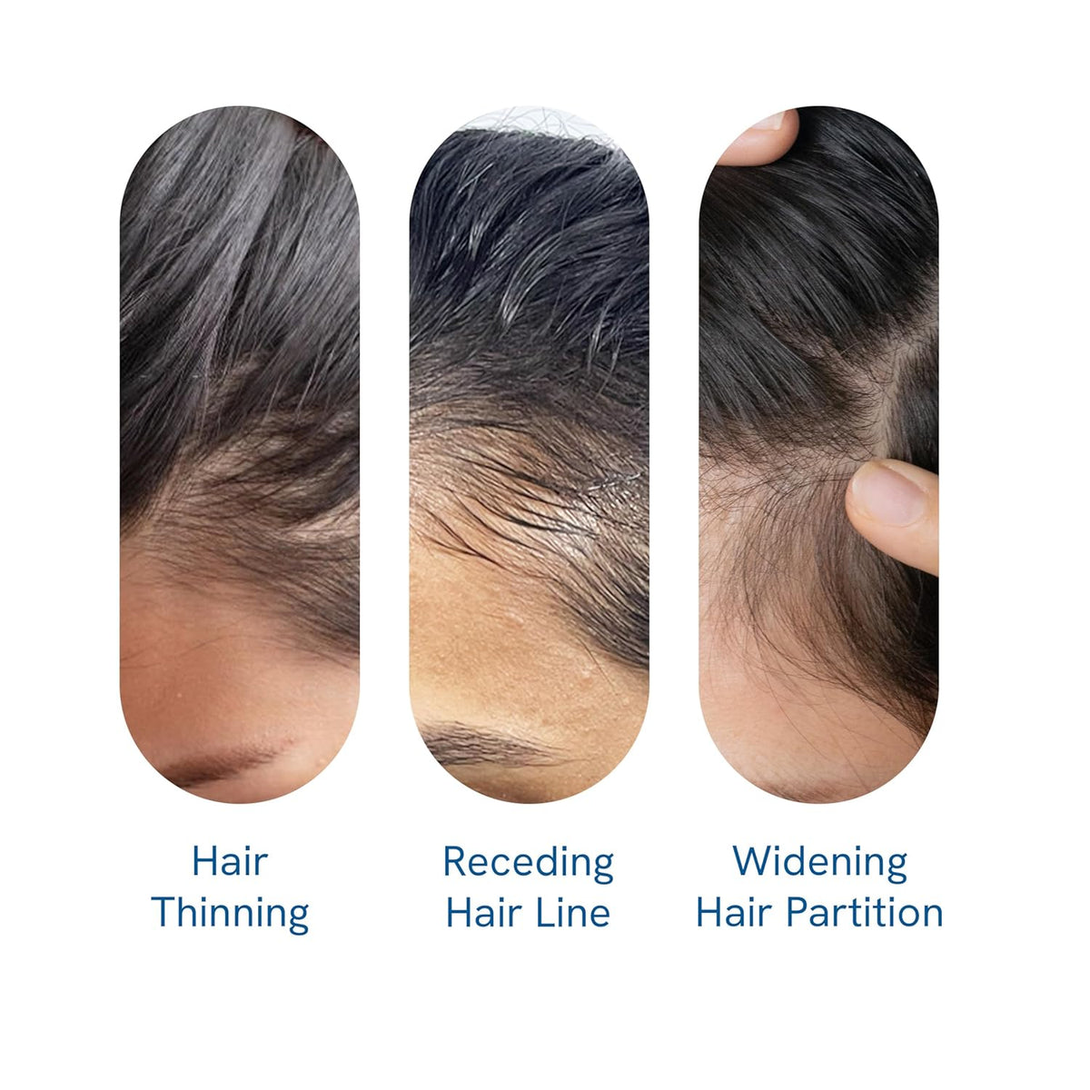 Findglee Hair Growth Serum Roll-On with Rosemary, Redensyl & Peptides