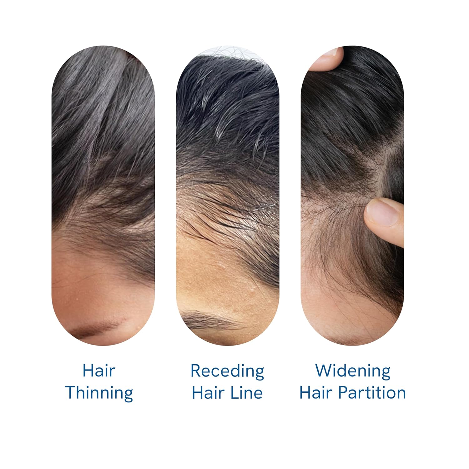 Findglee Hair Growth Serum Roll-On with Rosemary, Redensyl & Peptides