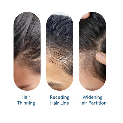 Findglee Hair Growth Serum Roll-On with Rosemary, Redensyl & Peptides