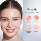 Acne Drying Lotion Plus - 3 Pack