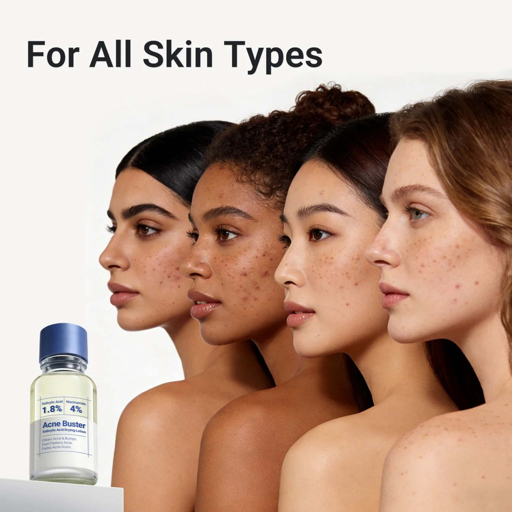 Acne Drying Lotion Plus - 3 Pack
