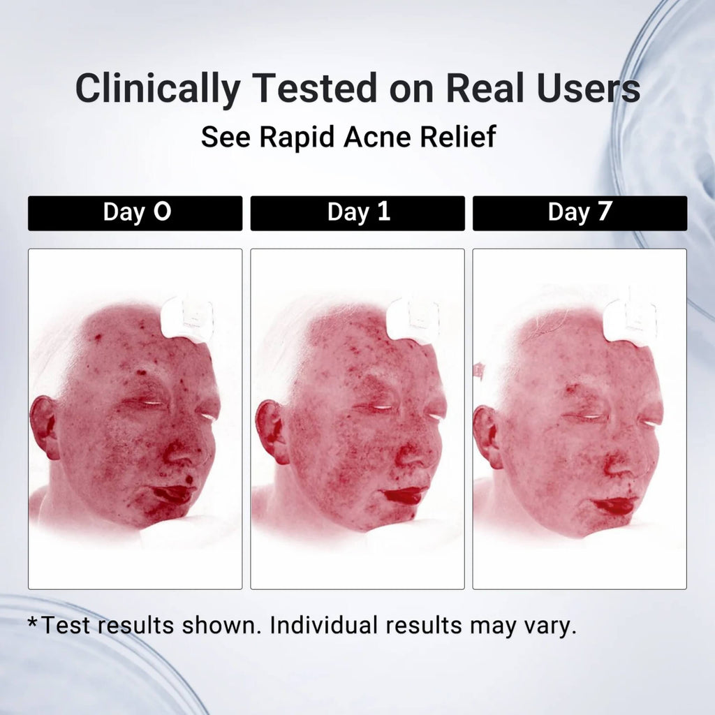 Acne Drying Lotion Plus - 3 Pack