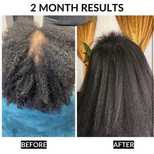 Findglee Healthy Hair Starter Kit 6-Piece Complete Hair Care Bundle for Stronger Hair