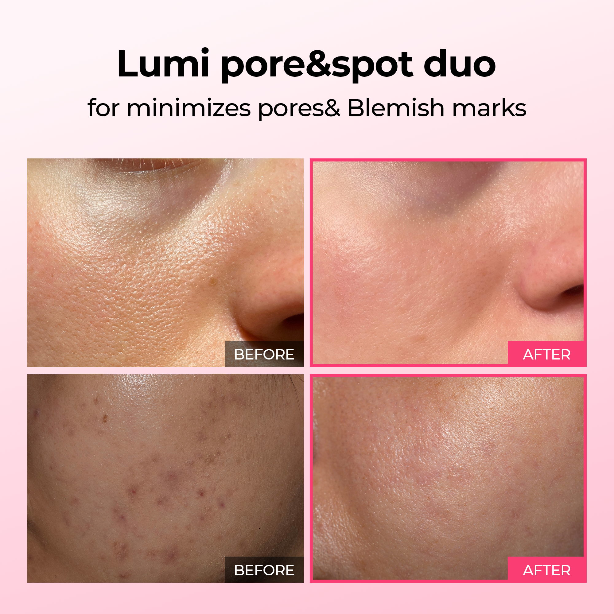 Findglee Lumi Pore & Spot Care Serum Duo Set for Pores, Dark Spots & Pigmentation